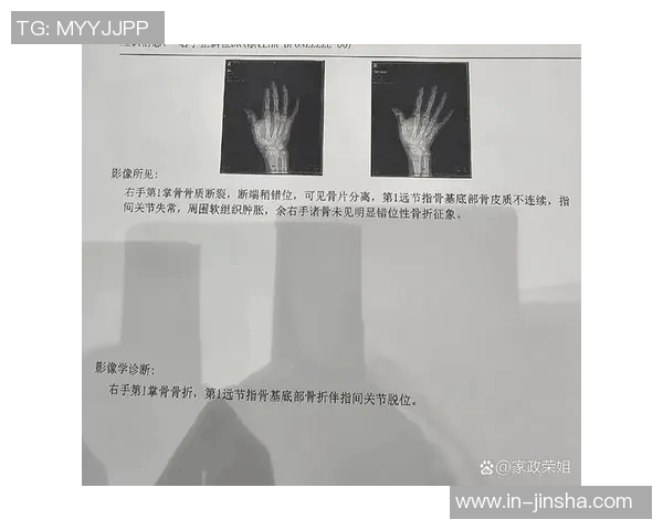 猛龙主帅透露博伊尔斯拇指受伤严重X光检查结果显示无骨折